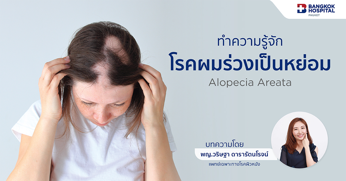 ทำความรูจัก “โรคผมร่วงเป็นหย่อม” (Alopecia Areata)